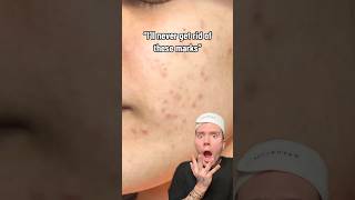 HOW TO GET RID OF ACNE SCARS😱follow for more💗 acne acnetreatment skincare skincareroutine [upl. by Ahgiel716]