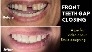 Front teeth gaping treatment with Zirconia Crowns  solution for space between front teeth [upl. by Maureene]