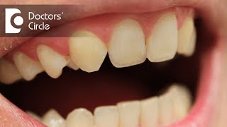 Everything about hypodontia  Dr Jayaprakash Ittigi [upl. by Gianina575]