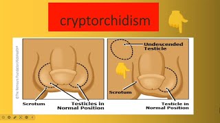 Cryptorchidism [upl. by Adnalram453]