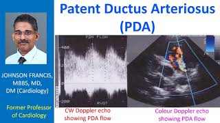 Patent Ductus Arteriosus PDA [upl. by Amaryl]