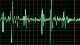 Congestive Heart Failure slow [upl. by Esidnak149]