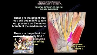 Ganglion cyst carpal tunnel  Everything You Need To Know  Dr Nabil Ebraheim [upl. by Ariaet]