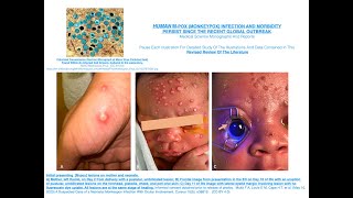 HUMAN M pox Monkeypox Infection And Morbidity Persist Since The Recent Global Outbreak [upl. by Yanehc]