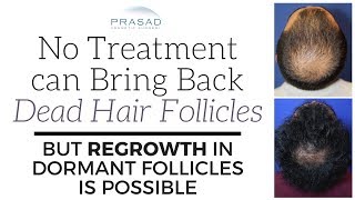 OILINESS AND HAIR LOSS HOW DHT PLAYS A KEY ROLE [upl. by Mccord]