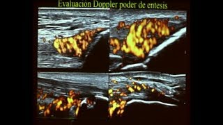 ECOGRAFIA DOPPLER MUSCULO ESQUELETICO Y ARTICULAR [upl. by Paz]