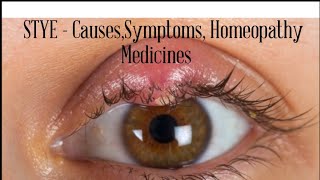 EYE STYE  CausesSymptoms amp its treatment eye stye medicine homeopathy viral [upl. by Metcalf176]