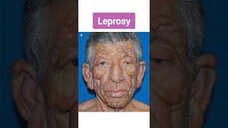 Leprosy  कुष्ट रोग का पूरा इलाज़ संभव है  यह परेशानी आपके हाथों को पूरा ख़राब कर देता है  leprosy [upl. by Mallis]