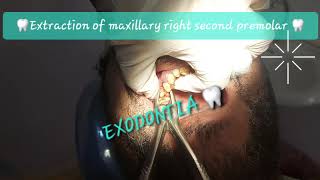 Buccal to lingual motion maxillary 2nd premolar extraction with double curvatures Sshaped roots [upl. by Waxler]