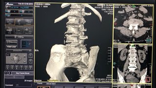 Lomber BT  Tomografi  Nasıl Çekilir  Disk Arasi Ve 3D İşlem Sonrası İslemler Nasıl Yapılır [upl. by Austin]