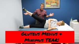 Gluteus Medius and Minimus tear vs Greater Trochateric Bursitis [upl. by Feliza]