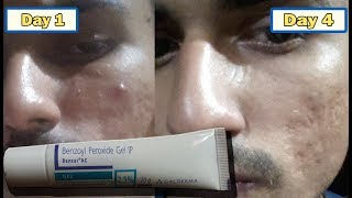 Acne transformation with Benzoyl peroxide 25 [upl. by Brietta]