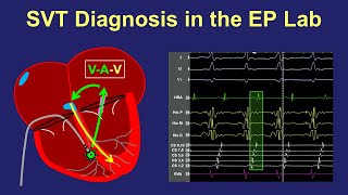 Diagnosis of SVT in the EP lab [upl. by Atteinotna265]