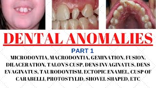 Developmental disturbances in teeth  Dental anomalies  Odontology notes  UGC NET Forensic science [upl. by Arymahs187]