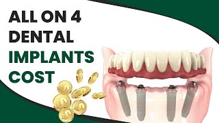 All On 4 Dental Implants Cost [upl. by Anilatsyrc]