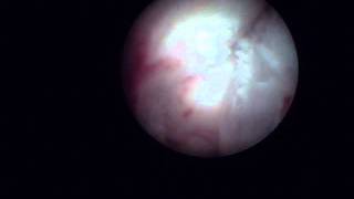 Arthroscopy of the Jaw Temporomandibular Joint TMJ  Part 1 [upl. by Gaige]