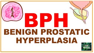 PATHOLOGY PRACTICAL  ENDOMETRIAL  BENIGN PROSTATIC HYPERPLASIA  NODULAR GOITER AND METAPLASIA [upl. by Niak]