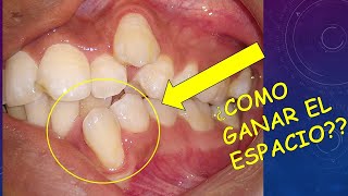 ¿Como se gana espacio para alinear dientes en la Ortodoncia evitando quitar dientes premolares 😎 [upl. by Vladimar]