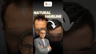 from Bald to Natural Hairline by Hair Transplant  Shocking results [upl. by Mauri]