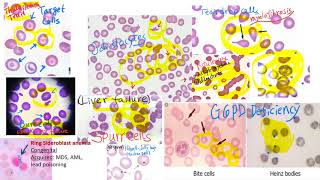 hematology in 10 min Peripheral blood smear examination under microscope [upl. by Sammy342]