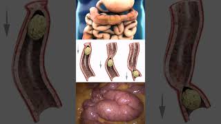 intestinal peristalsis [upl. by Leiru]