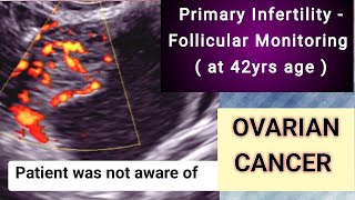 Ultrasound Infertility  Ovarian Cancer [upl. by Yelekreb896]