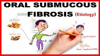 Oral Submucous Fibrosis OSMF Etiology [upl. by Amehsyt851]