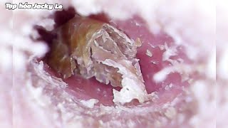 Ear Wax Removal 220 The earwax was so big that it made him itch like crazy  Ear Cleaning ASMR [upl. by Cohl244]