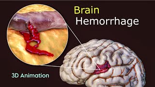 What Triggers Brain Hemorrhage  3D Animation  Scopic Vision [upl. by Rozina]