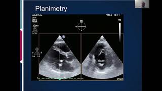 Joint Echo Conference Mitral Stenosis [upl. by Peper245]