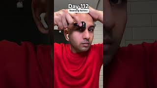 Day112 of Restoring Hairline [upl. by Aronaele]