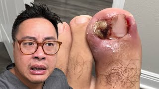 IS THIS THE WORSE INGROWN YOU EVER SEEN [upl. by Edin]