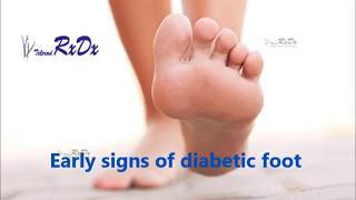 Early Signs of Diabetic Foot [upl. by Ycnan537]