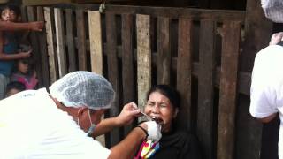 Fastest Extractions Dental Mission Mar 12 2012 Project PEARLS [upl. by Enileoj]