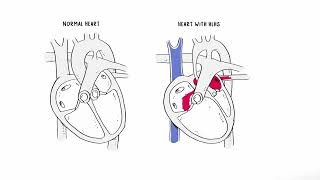 Hypoplastic left heart syndrome Year of the Zebra 2024 [upl. by Llerruj]