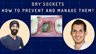 Dry Sockets  How to Prevent and Manage Them Oral Surgery Complications  GF010 [upl. by Cassius]