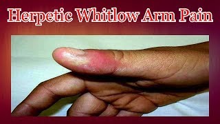 Herpetic Whitlow Arm Pain [upl. by Dorian692]