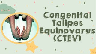 Congenital Talipes Equinovarus CTEV [upl. by Ayatnwahs]