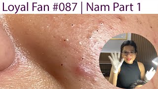 Acne Treatment Huong Da Nang 087  Loyal fans  Nam Part 1 [upl. by Sammie459]