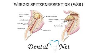 Wurzelspitzenresektion WSR ablauf [upl. by Aznarepse80]