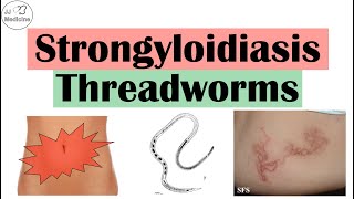 Strongyloidiasis Threadworms  Causes Pathophysiology Signs and Symptoms Diagnosis Treatment [upl. by Gayn]