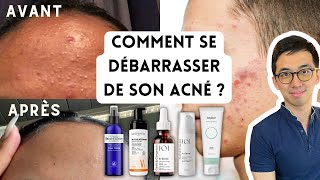 PEAU SANS ACNÉ  BOUTONS BLANCS OU ROUGES MICROKYSTES PLAQUES DE BOUTONS PAPULES PUSTULES [upl. by Kaete887]