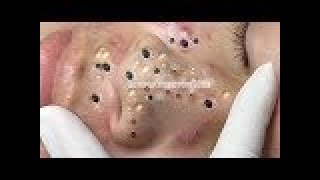 Black head removed from nose  Loan Nguyen latest video 0629 cystic blackheads whiteheads removal [upl. by Elylrac]