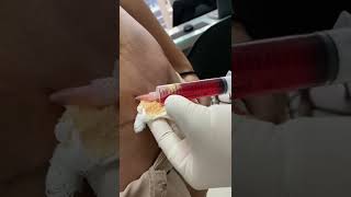 Seroma em abdominoplastia [upl. by Kacey]