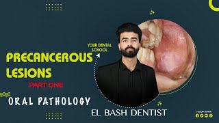 precancerous lesions  oral pathology  عزت شومان [upl. by Gereld]