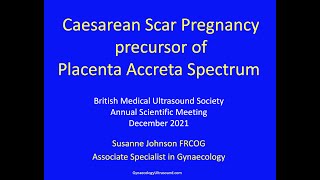 Caesarean Scar Pregnancy precursor of Placenta Accreta Spectrum [upl. by Fenella586]