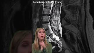 Symptomatic Tarlov Cysts nervedamage neurology neuropathicpain tarlovcyst [upl. by Aihsal]