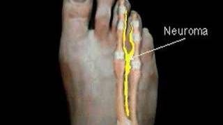 Excision of Mortons Neuroma  Surgical Animation [upl. by Mir]