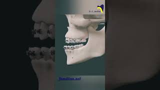 Le Fort I osteotomy for maxillary advancement dentistOsteotomy orthodontistMaxillaryAdvancement [upl. by Roid]