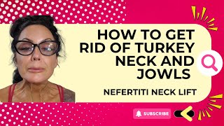 How to map for Nefertiti neck lift [upl. by Ahsac]